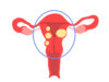 Illustration einer Gebärmutter mit Myomen, eingekreister Bereich wird bei einer radikalen Hysterektomie entfernt.